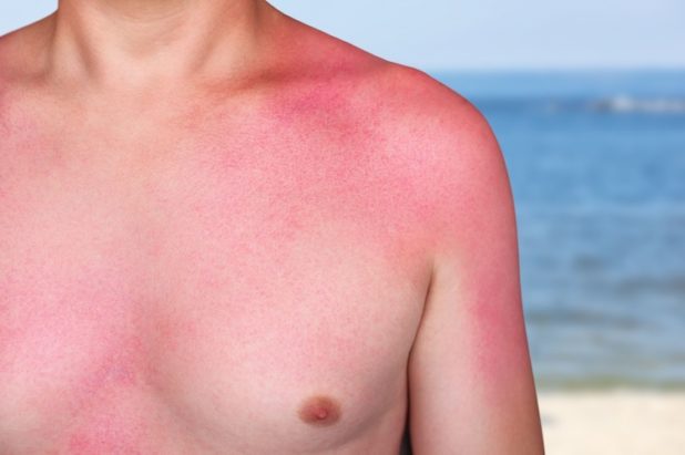 UV-Strahlung ist der größte Risikofaktor für schwarzen Hautkrebs.
